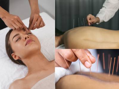 Acupuncture Therapy